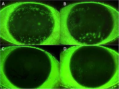Use of allogeneic platelet-rich plasma for the treatment of autoimmune ocular surface disorders: case series